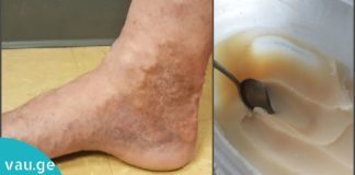 ვენების თრომბოზს ამ ორი ინგრედიენტის დახმარებით უმკურნალებთ. ეფექტურია