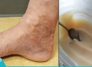 ვენების თრომბოზს ამ ორი ინგრედიენტის დახმარებით უმკურნალებთ. ეფექტურია