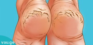 ეს ეთერზეთები დამსკდარ ქუსლებს სამუდამოდ დაგავიწყებთ. ყველაზე იაფი და ეფექტური მეთოდი