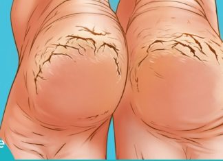 ეს ეთერზეთები დამსკდარ ქუსლებს სამუდამოდ დაგავიწყებთ. ყველაზე იაფი და ეფექტური მეთოდი