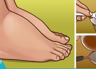 სითხის შეკავებით გამოწვეული შეშუპება, გაიგეთ ამ პრობლემის მოგვარების 5 მეთოდი…