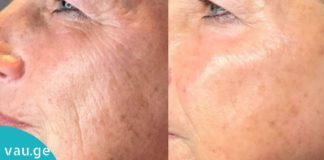 ბოტოქსი სახლის პირობებში: ეს ნაოჭების საწინააღმდეგო ნიღბები დაეხმარება თქვენს კანს!