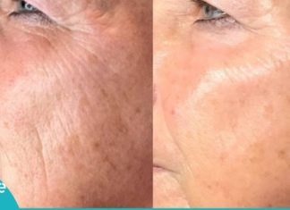 ბოტოქსი სახლის პირობებში: ეს ნაოჭების საწინააღმდეგო ნიღბები დაეხმარება თქვენს კანს!