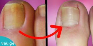 მხოლოდ 2 ინგრედიენტი იმისათვის, რომ სამუდამოდ განთავისუფლდეთ ფრჩხილის სოკოსგან.