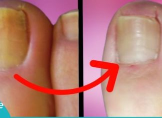 მხოლოდ 2 ინგრედიენტი იმისათვის, რომ სამუდამოდ განთავისუფლდეთ ფრჩხილის სოკოსგან.