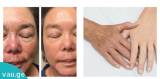 ექვსი ძალიან ეფექტური მეთოდი, რომელიც პიგმენტურ ლაქებს ერთხელ და სამუდამოდ დაგავიწყებთ