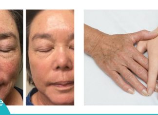 ექვსი ძალიან ეფექტური მეთოდი, რომელიც პიგმენტურ ლაქებს ერთხელ და სამუდამოდ დაგავიწყებთ