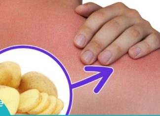 კისერზე მარილები დაგიგროვდათ? ეს კარტოფილის კომპრესი ტკივილს სამუდამოდ დაგავიწყებთ!