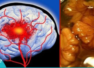 გაიწმინდეთ თავის ტვინის სისხლძარღვები ამ ნაცადი და ძალიან ეფექტური მეთოდებით