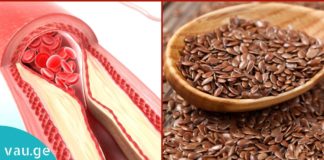 ათეროსკლეროზი – იმკურნალეთ სანამ გვიან არაა. რეცეპტი, რომელიც იდეალურ შედეგს მოგცემთ