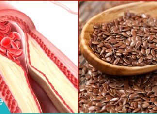 ათეროსკლეროზი – იმკურნალეთ სანამ გვიან არაა. რეცეპტი, რომელიც იდეალურ შედეგს მოგცემთ