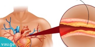 როგორ შევამციროთ ქოლესტერინის დონე სისხლში. გაითვალისწინეთ ეს რჩევები