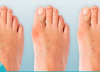 პოდაგრის მკურნალობის ყველაზე მარტივი და ეფექტური გზა. მხოლოდ იოდი და ასპირინი დაგჭირდებათ