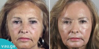 სახამებლის დაუჯერებელი ეფექტი სახის კანზე. ის, რაც ყველა მანდილოსანმა უნდა იცოდეს