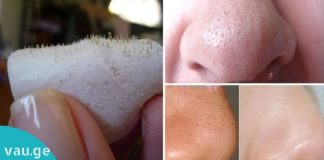 ეფექტური მეთოდი, რომლის დახმარებით შავი წერტილების და ღია ფორების შესახებ დაივიწყებთ!