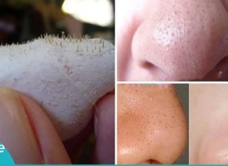 ეფექტური მეთოდი, რომლის დახმარებით შავი წერტილების და ღია ფორების შესახებ დაივიწყებთ!