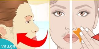 მოიშორეთ სახიდან არასასურველი თმა სახლის პირობებში. იაფი და ეფექტური მეთოდები