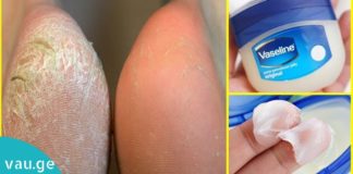 საუკეთესო საშუალება ქუსლების სამკურნალოდ! ეფექტურია!