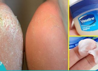 საუკეთესო საშუალება ქუსლების სამკურნალოდ! ეფექტურია!