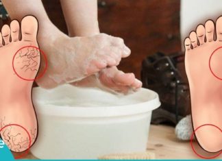 გათავისუფლდით კოჟრისა და დამსკდარი ქუსლებისგან მხოლოდ 10 დღეში! უმარტივესია…