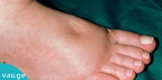 ყველაზე ძლიერი ბუნებრივი საშუალება ფეხების შეშუპების წინააღმდეგ! დაივიწყეთ ეს პრობლემა სამუდამოდ!