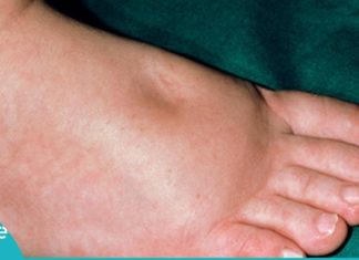 ყველაზე ძლიერი ბუნებრივი საშუალება ფეხების შეშუპების წინააღმდეგ! დაივიწყეთ ეს პრობლემა სამუდამოდ!