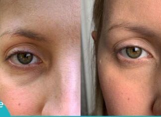 თუ თვალების ირგვლივ სიშავეები და შეშუპება გაწუხებთ, ეს 7 რჩევა თქვენთვისაა!