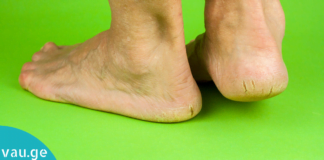 აი ასე მარტივად გათავისუფლდებით აქერცლილი და დახეთქილი ქუსლებისგან!