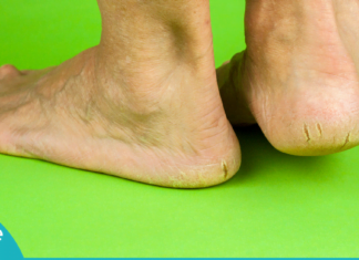 აი ასე მარტივად გათავისუფლდებით აქერცლილი და დახეთქილი ქუსლებისგან!