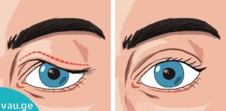 ჩამოწეული ქუთუთოების პრობლემა თუ გაწუხებთ, ეს უნდა სცადოთ! გაიგეთ მეტი…