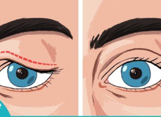 ჩამოწეული ქუთუთოების პრობლემა თუ გაწუხებთ, ეს უნდა სცადოთ! გაიგეთ მეტი…