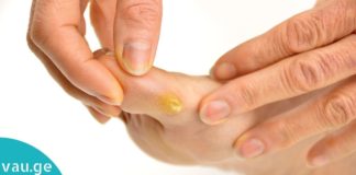 კოჟრების მოშორების მარტივი და ეფექტური ხერხი. ეს ინფორმაცია აუცილებლად გამოგადგებათ