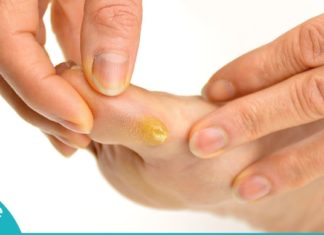 კოჟრების მოშორების მარტივი და ეფექტური ხერხი. ეს ინფორმაცია აუცილებლად გამოგადგებათ