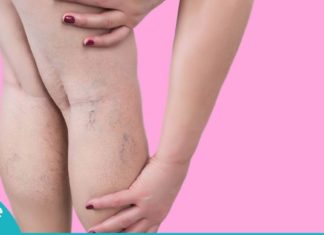 შეშუპებული კიდურების სამკურნალო ბუნებრივი მეთოდები- ეფექტურია!