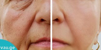 როგორ მოვიშოროთ ნაოჭები სწრაფად და მარტივად? ყველაზე ეფექტური საშუალებაა!