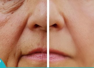 როგორ მოვიშოროთ ნაოჭები სწრაფად და მარტივად? ყველაზე ეფექტური საშუალებაა!