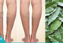 განიკურნეთ ვენების ვარიკოზული გაგანიერებისგან დაფნის ფოთლების დახმარებით. შედეგი, რომელზეც ყველა აღტაცებით საუბრობს