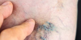 აი ასე უნდა უმკურნალოთ ვარიკოზულ ვენებს