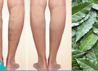 განიკურნეთ ვენების ვარიკოზული გაგანიერებისგან დაფნის ფოთლების დახმარებით. შედეგი, რომელზეც ყველა აღტაცებით საუბრობს