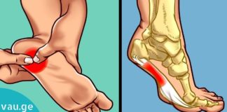 საუკეთესო საშუალება ქუსლების ტკივილის სამკურნალოდ! ეფექტურია!