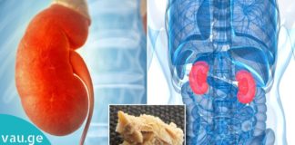 რა სიმპტომები აქვს თირკმელში კენჭებს და როგორ უნდა ვუმკურნალოთ!