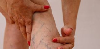 ექიმები მალავენ! მარტივი საშუალება ვარიკოზის სახლში სამკურნალოდ! დააჭირე…