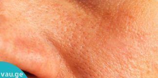 მხოლოდ 2 ნაცნობი ინგრედიენტი, რომელიც თქვენს სახეზე გაფართოებულ ფორებს დამალავს!