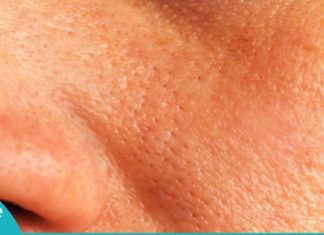 მხოლოდ 2 ნაცნობი ინგრედიენტი, რომელიც თქვენს სახეზე გაფართოებულ ფორებს დამალავს!