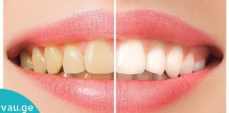 6 მარტივი გზა კბილების გასათეთრებლად-მხოლოდ ბუნებრივი საშუალებები!