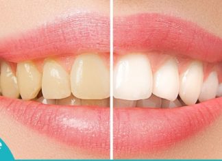 6 მარტივი გზა კბილების გასათეთრებლად-მხოლოდ ბუნებრივი საშუალებები!
