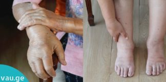 როგორ უნდა მოიქცეთ, როდესაც ხელები ან ფეხები გიშუპდებათ? საჭირო და ეფექტური რჩევა