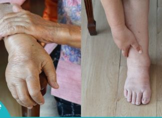 როგორ უნდა მოიქცეთ, როდესაც ხელები ან ფეხები გიშუპდებათ? საჭირო და ეფექტური რჩევა