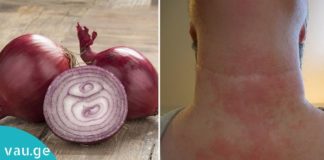 მან ყელი ხახვით შეიხვია და დაიძინა. როდესაც გაიღვიძა შედეგით გაოგნებული დარჩა