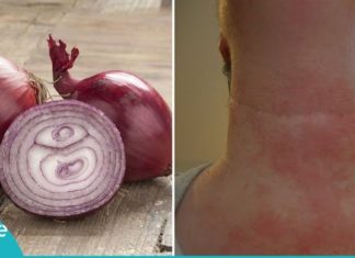 მან ყელი ხახვით შეიხვია და დაიძინა. როდესაც გაიღვიძა შედეგით გაოგნებული დარჩა